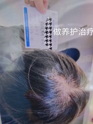 体验前-北京雍禾植发医院