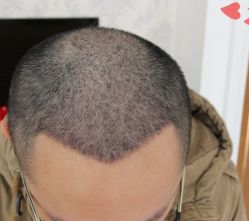 -大麦微针植发丨全国连锁