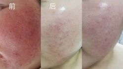 -瓷肌博士·祛痘科技美肤