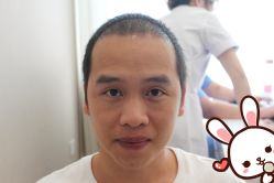 点击看大图 -大麦微针植发丨全国连锁