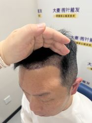 体验后-大麦微针植发全国连锁