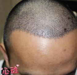 -大麦微针植发丨全国连锁