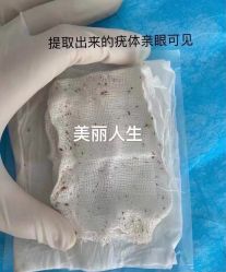 -爱莎扁平疣·汗管瘤·斑痣中心