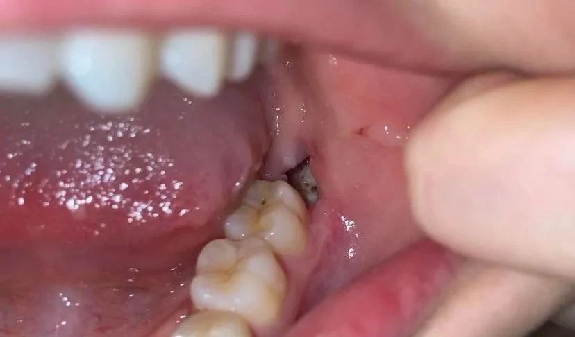 干槽症又称局限性牙槽骨炎,纤维蛋白溶解性