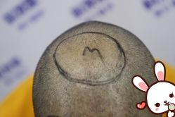 点击看大图 -大麦微针植发丨全国连锁