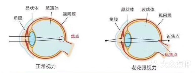 老花眼正常吗？