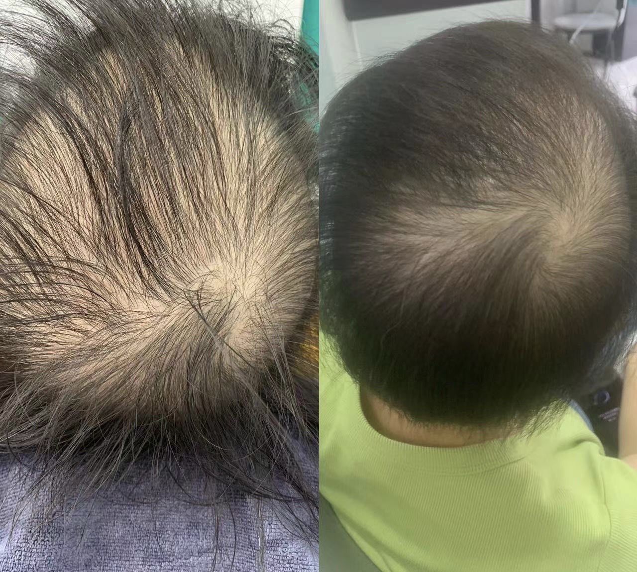 女性弥漫性脱发