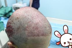 点击看大图 -大麦微针植发丨全国连锁