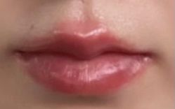 体验后-美莱医学美容医院