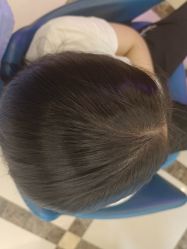 -碧莲盛·不剃发植发