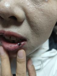 点击看大图 -北京美痣堂古方祛痣斑疣瘊