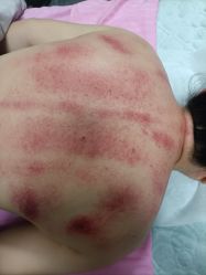 -苗塑堂减肥艾灸