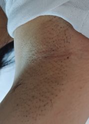 点击看大图 体验后-烟台曙光医疗美容医院