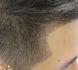 -大麦微针植发丨全国连锁