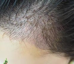 -大麦微针植发丨全国连锁