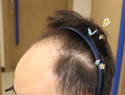 -大麦微针植发全国连锁