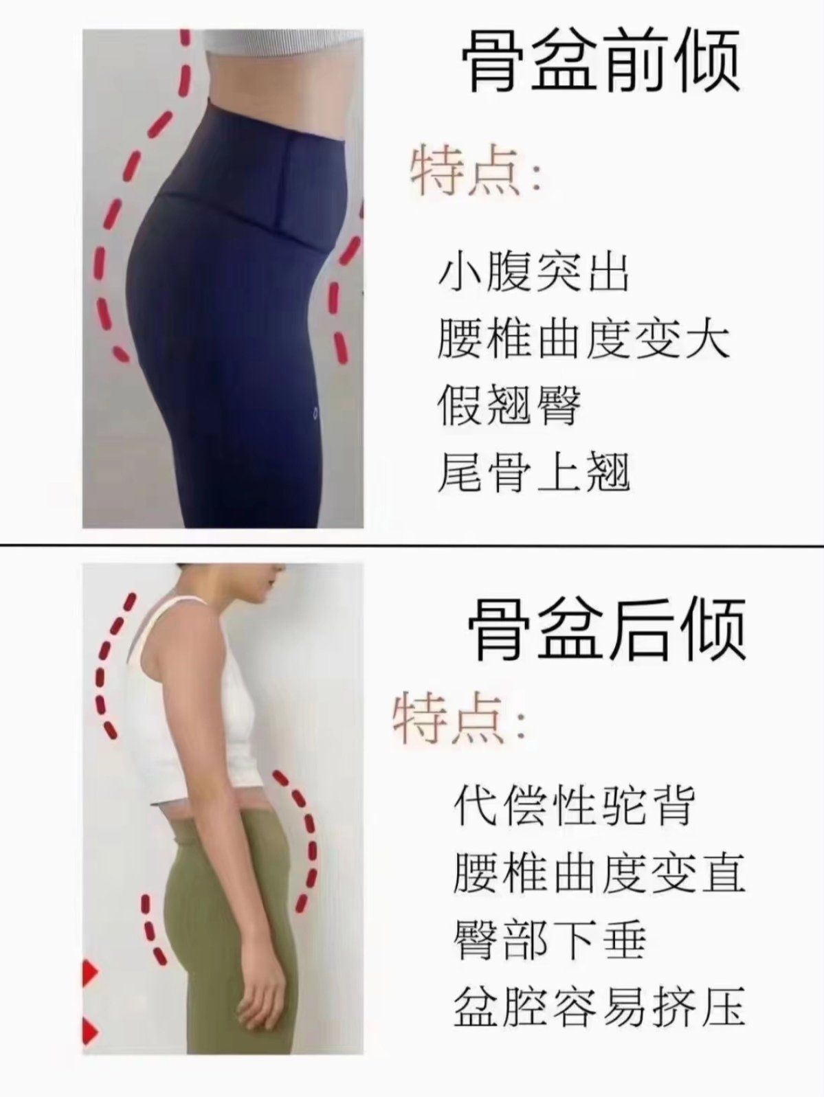 」#芊芊悦美瑜伽普拉提#邵阳#如何判断骨盆后倾