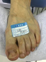 点击看大图 -派恩宜灰指甲鸡眼嵌甲手足癣