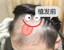 -大麦微针植发全国连锁