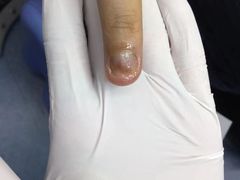 -Andrew指甲专科灰指甲·甲沟炎矫正·3D步态矫形鞋垫定制(浦三路店)