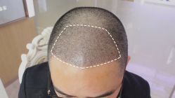 -大麦微针植发丨全国连锁