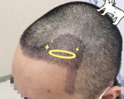 -大麦微针植发全国连锁