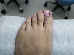 -派恩宜灰指甲鸡眼嵌甲手足癣