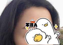 -大麦微针植发全国连锁