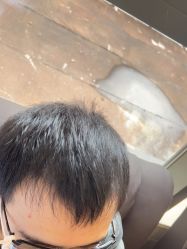 -碧莲盛·不剃发植发