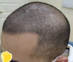 -大麦微针植发丨全国连锁