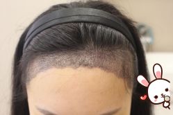 -大麦微针植发丨全国连锁