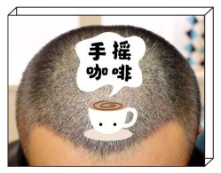 -大麦微针植发全国连锁