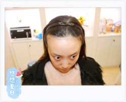 点击看大图 体验后-大麦微针植发全国连锁