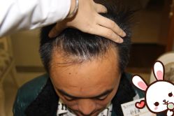 点击看大图 -大麦微针植发丨全国连锁