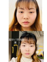 体验后-成都艾特他整形外科医院