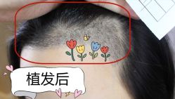 -大麦微针植发全国连锁