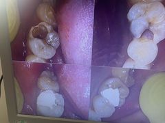 -上海仁爱医院口腔科 · 种植