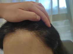 -碧莲盛·不剃发植发