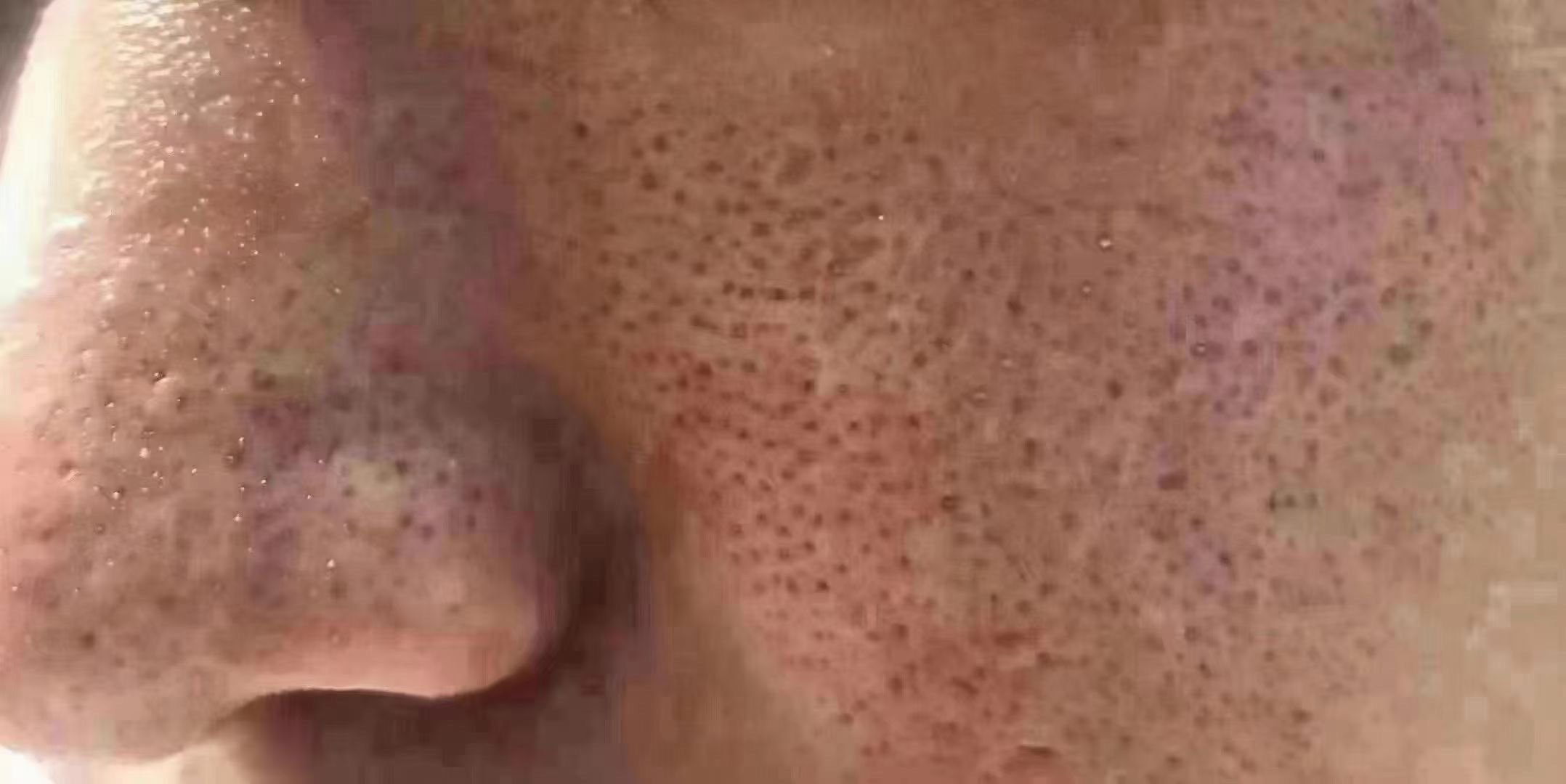 毛孔粗大,堵塞严重拉低颜值