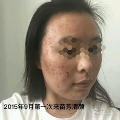 -苗方清颜专业祛痘