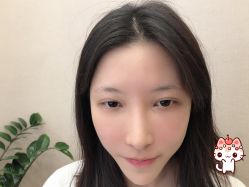 -大麦微针植发丨全国连锁