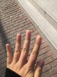 -德哥灰指甲脚气甲沟炎跖疣护理