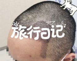 -大麦微针植发全国连锁