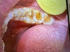 -上海仁爱医院口腔科 · 种植