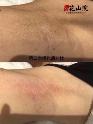 -觅屿日式脱毛美肤