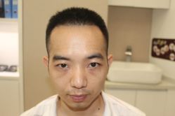 点击看大图 -大麦微针植发丨全国连锁