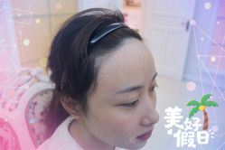 -大麦微针植发全国连锁