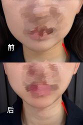 -小梨·OndaPro·专业脱毛连锁机构