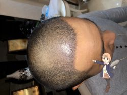 -大麦微针植发丨全国连锁