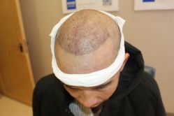 -大麦微针植发丨全国连锁